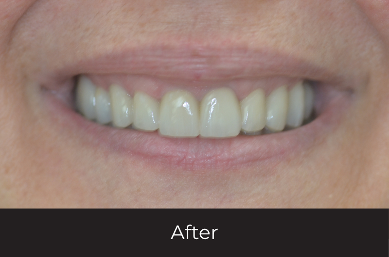 Restoring A Collapsed Bite With Full Mouth Reconstruction