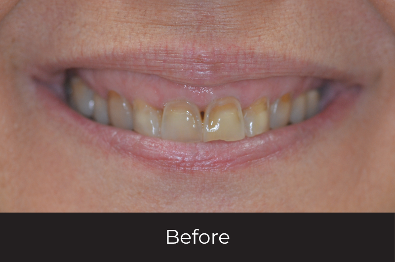 Restoring A Collapsed Bite With Full Mouth Reconstruction