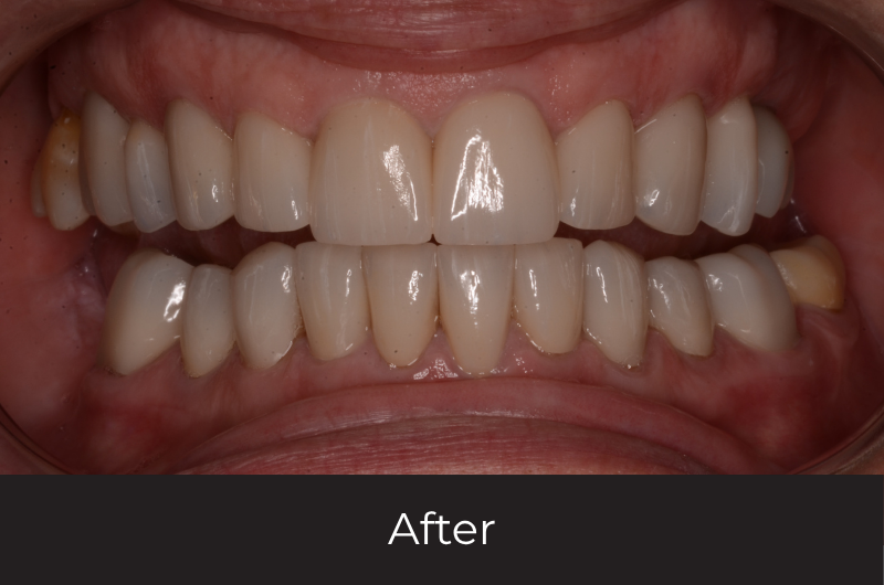 Restoring A Collapsed Bite With Full Mouth Reconstruction