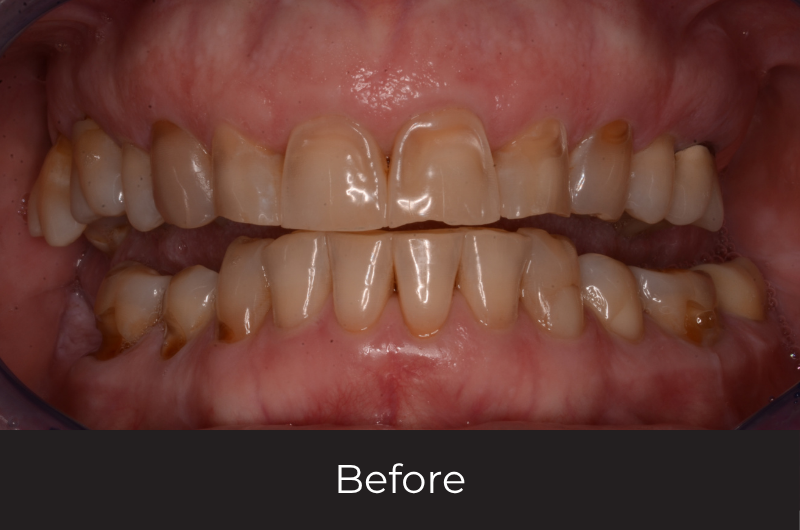 Restoring A Collapsed Bite With Full Mouth Reconstruction